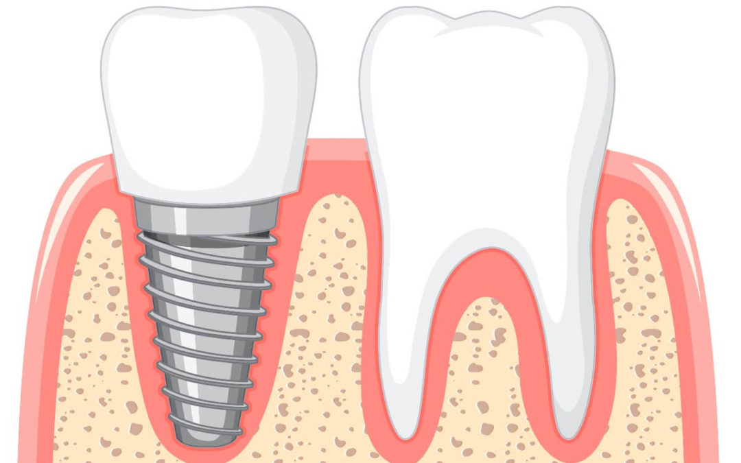 Implantes Dentales San Miguel