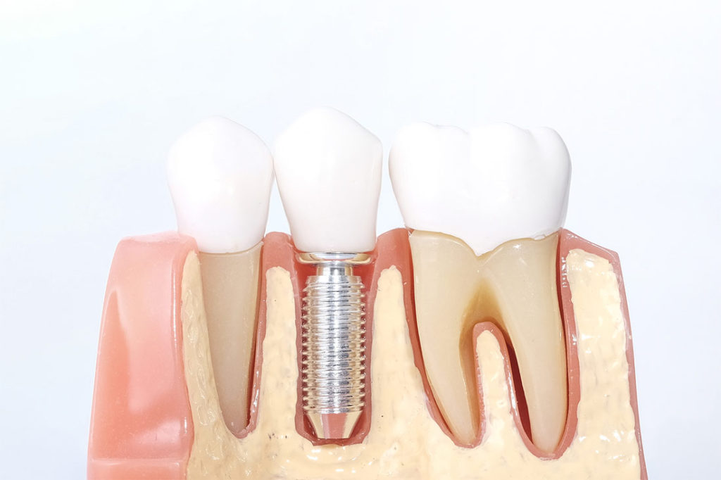 Implantes Dentales Puente Alto