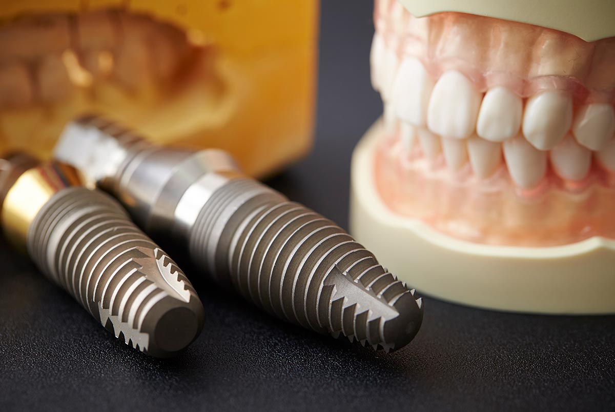 Implantes Dentales San Bernardo