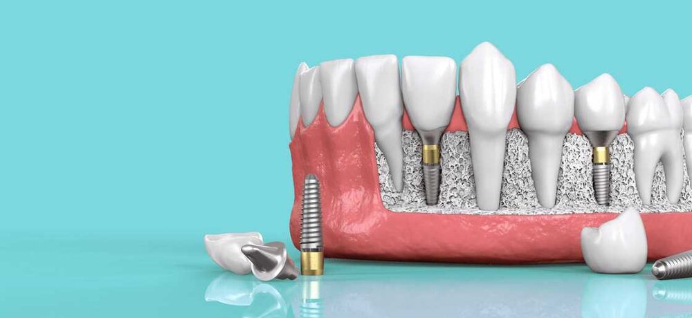 Implantes Dentales Santiago Centro
